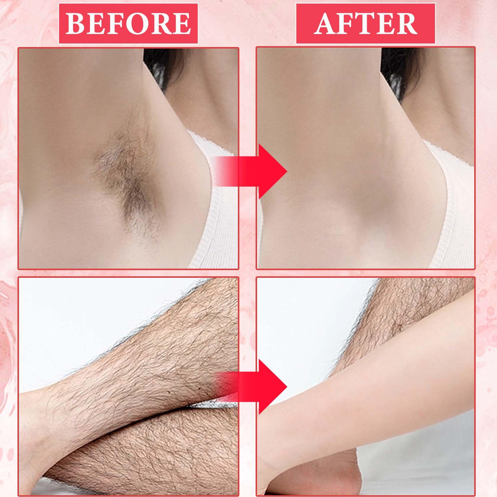 DuoZeng applied during IPL device treatment for comfort benefit
