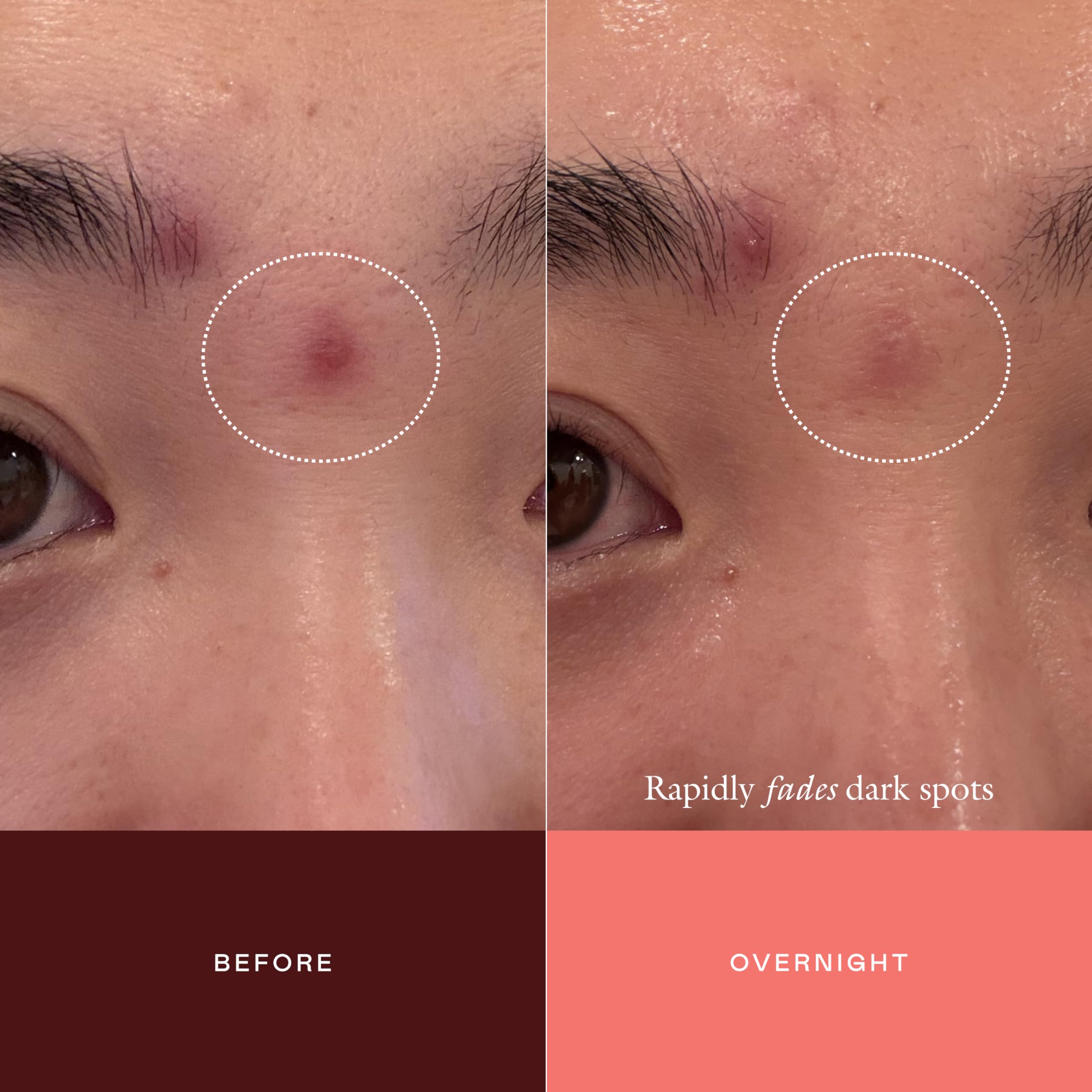 EADEM The Mark adhered to a small skin spot demonstrating localized delivery benefit