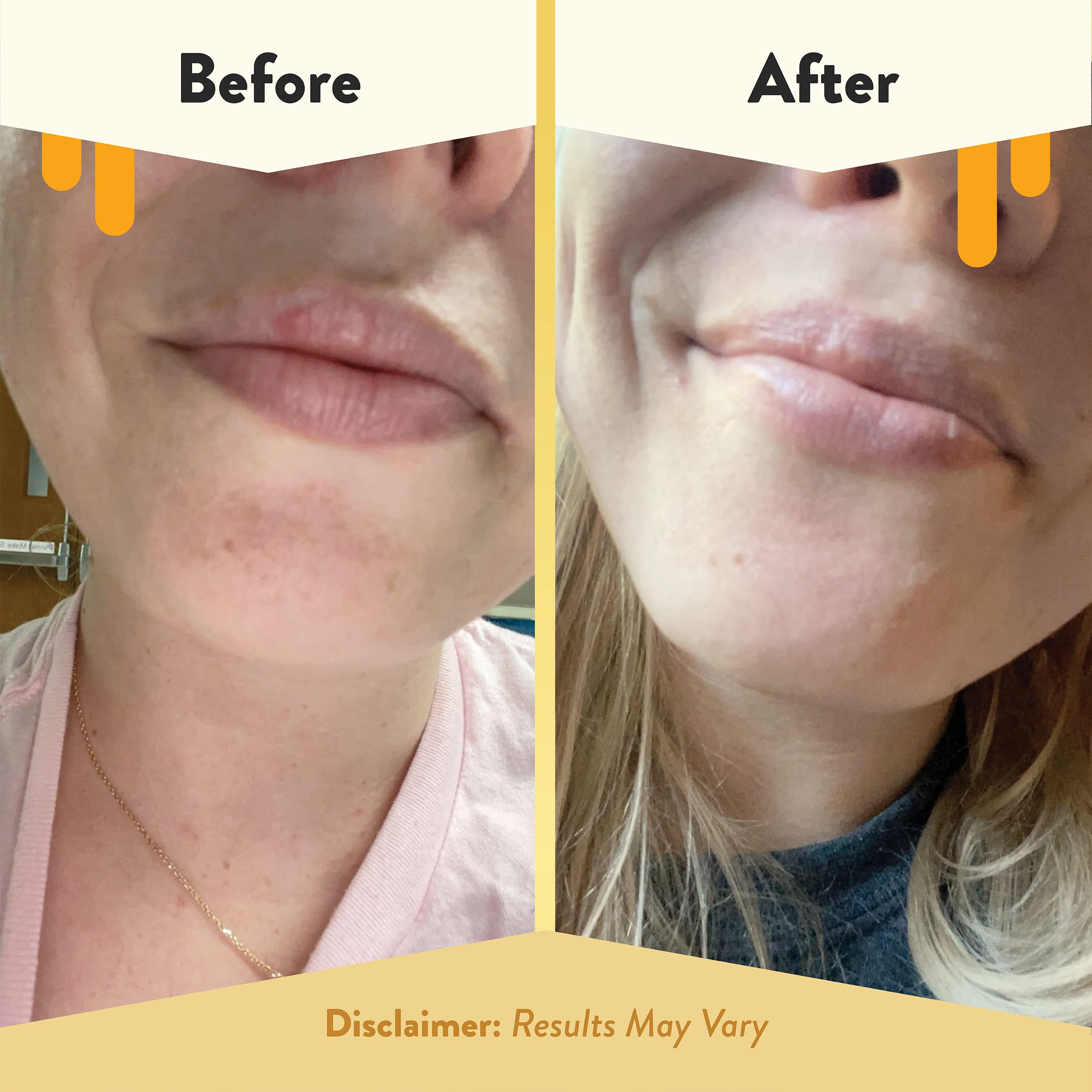 ECZEMA HONEY balm being applied on lips demonstrating soothing hydration