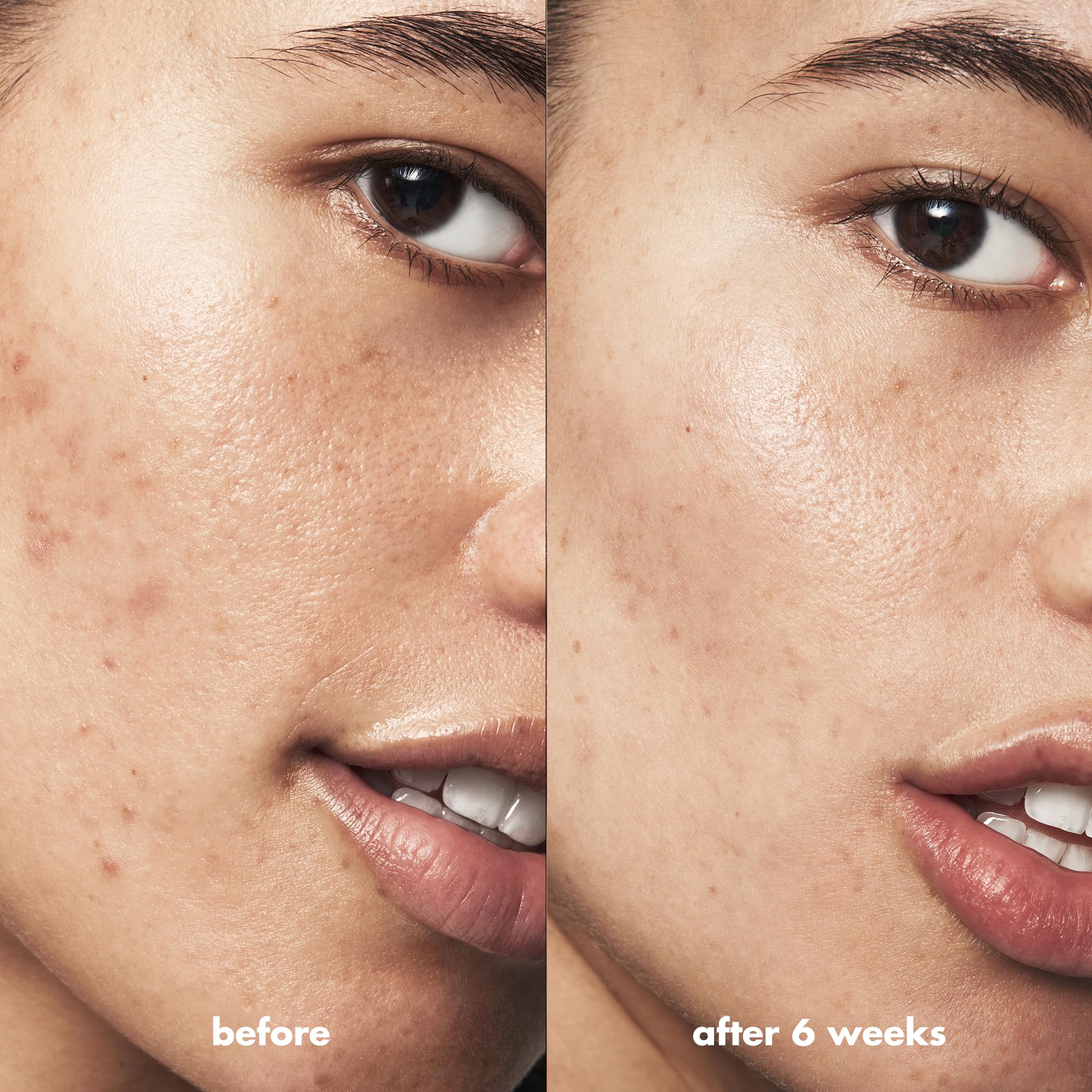 e.l.f. product in use on chin spot illustrating easy no-touch application for fast treatment