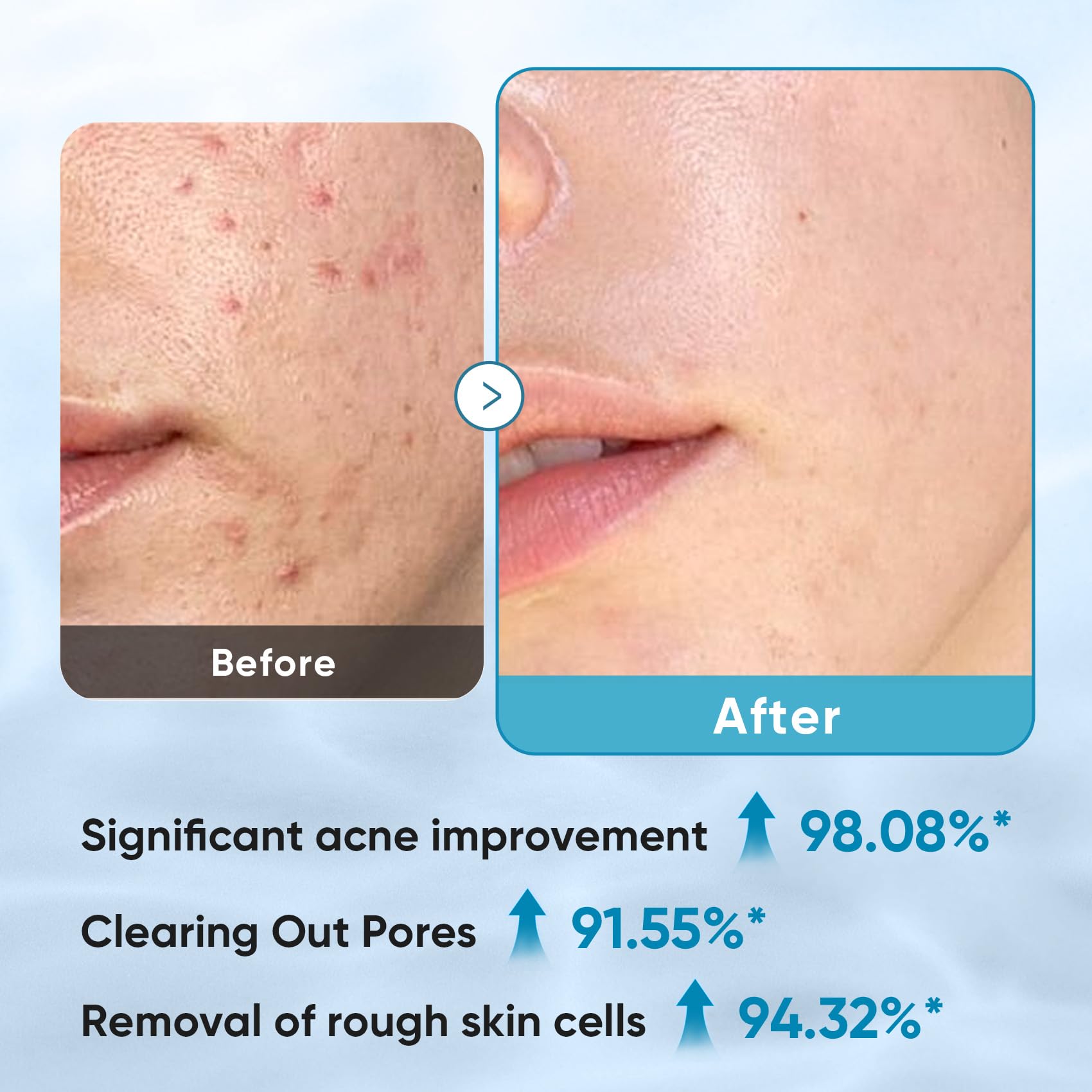 Elvira solution drop on pad demonstrating saturated peel pad benefit