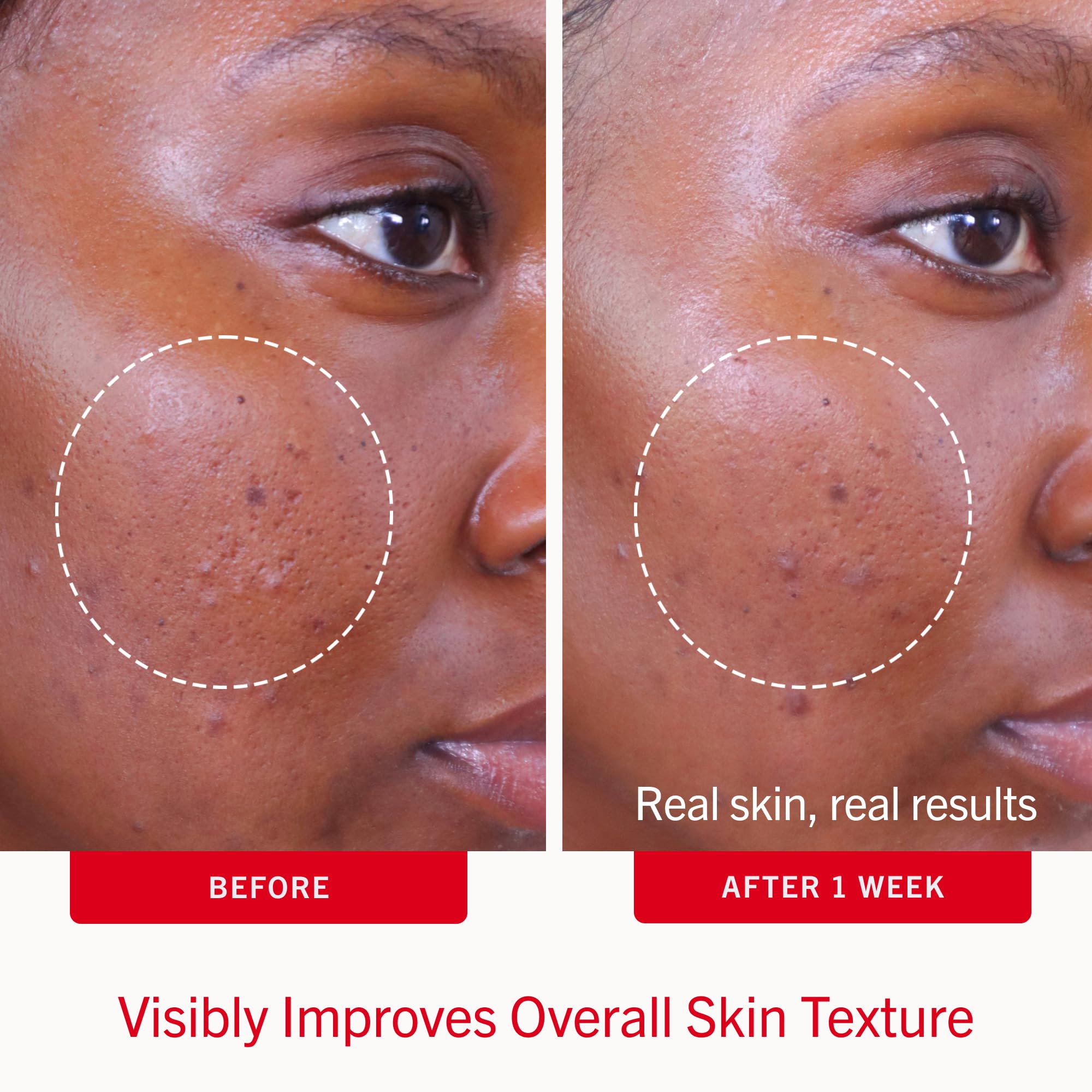 First Aid Beauty pad soaked in solution highlighting consistent salicylic delivery