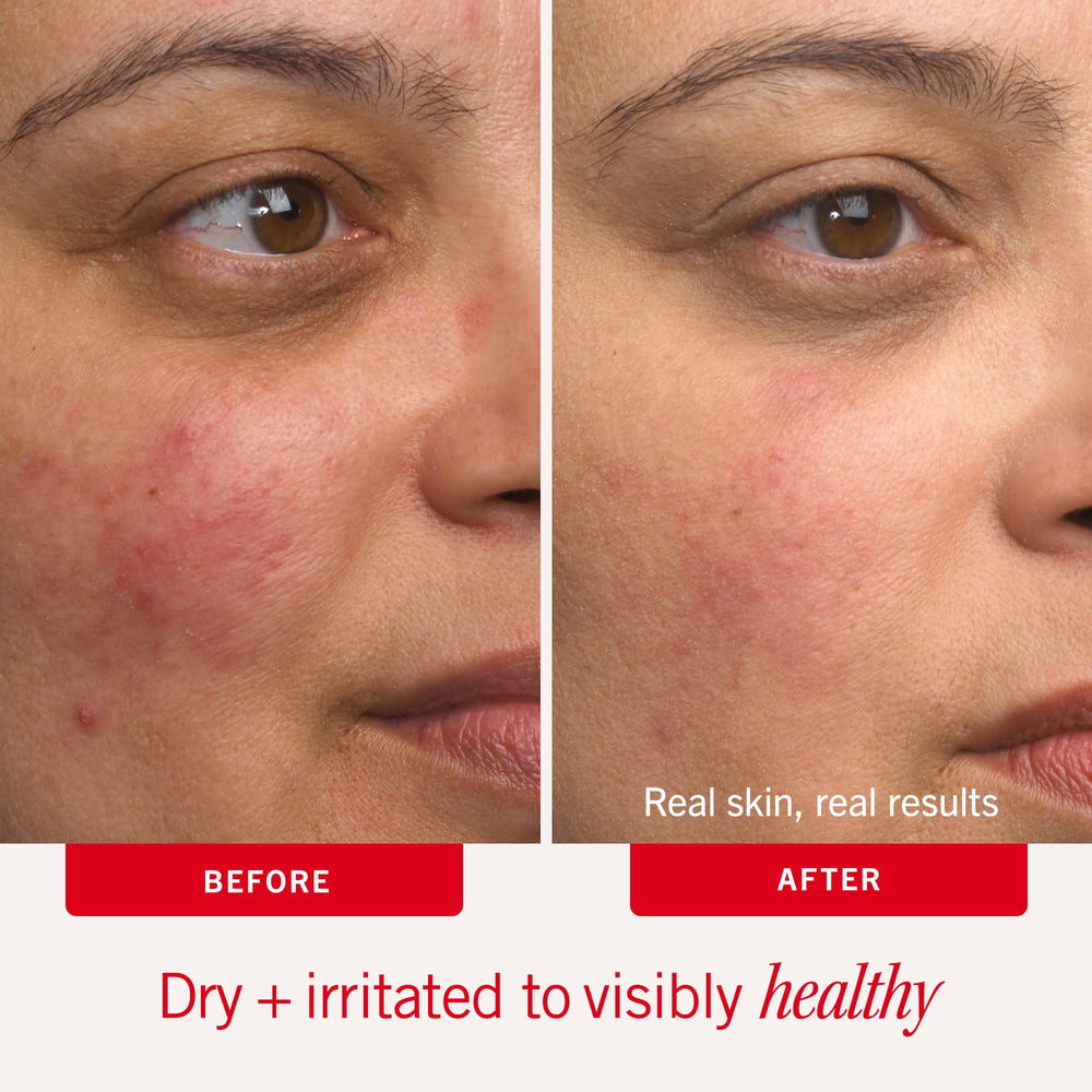 First Aid Beauty being smoothed on face to soothe dry, sensitive skin