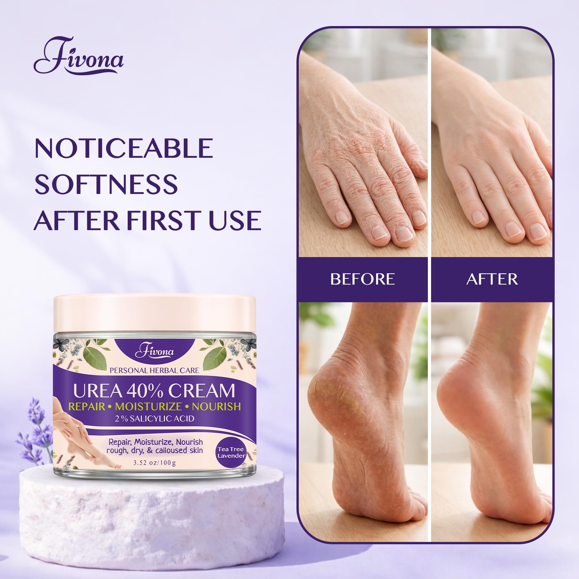 FIVONA before and after callus improvement showing visible smoothing