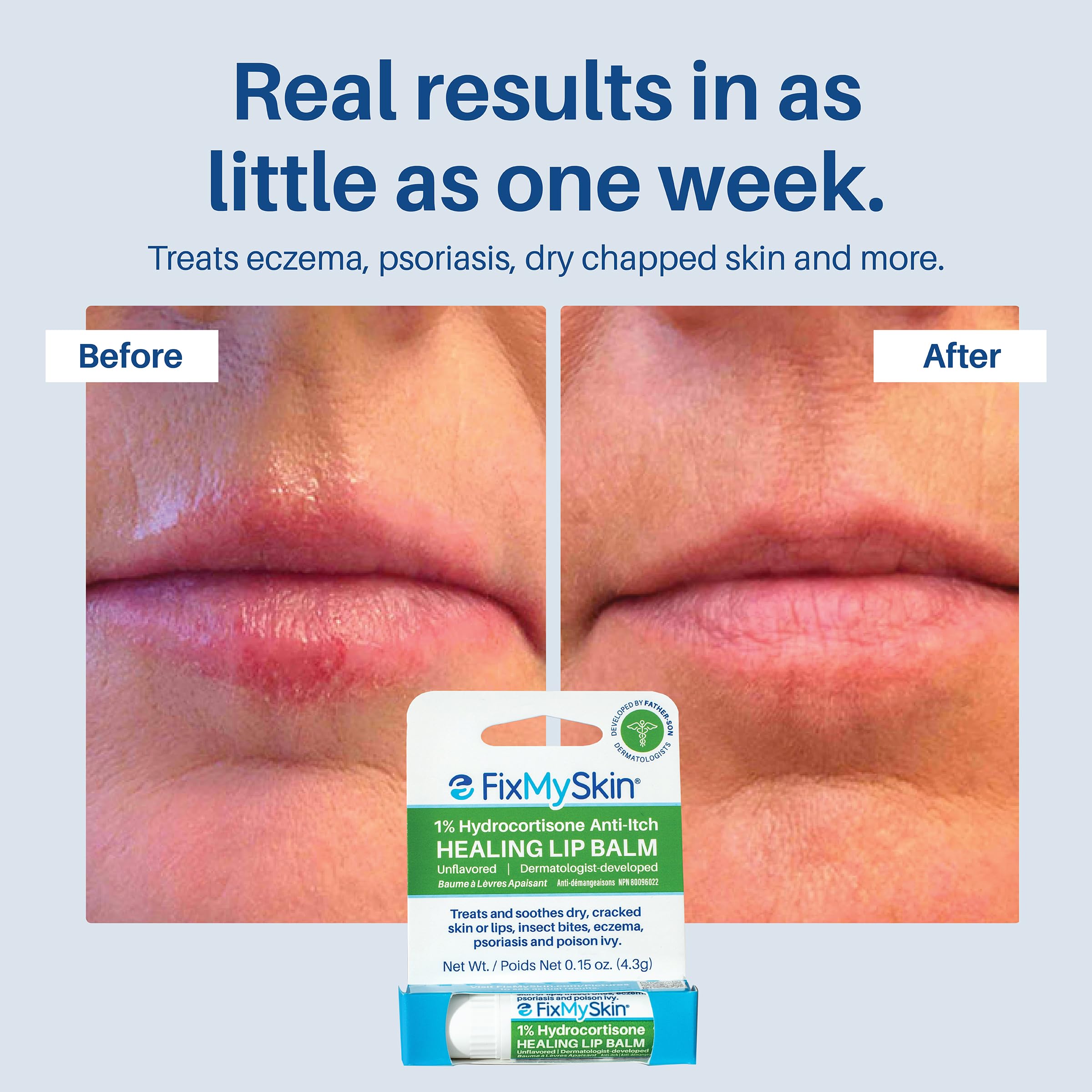 FixMySkin ingredient label highlighting 1% hydrocortisone for inflammation relief benefits