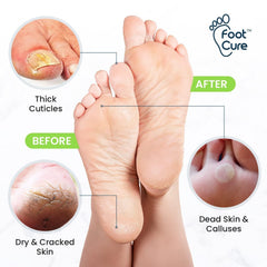 FOOT CURE applying callus gel to heel demonstrating easy targeted treatment