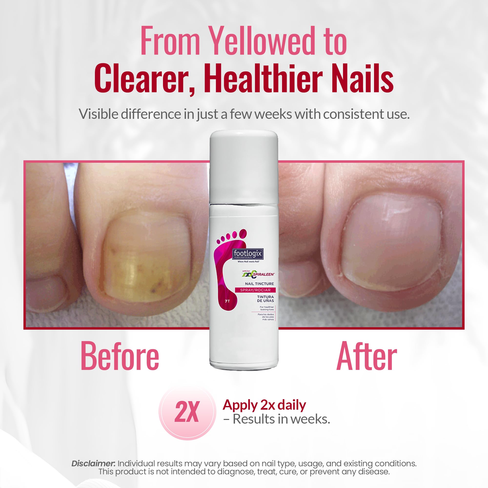 FOOTLOGIX being sprayed onto a toenail showing easy, neat application benefit