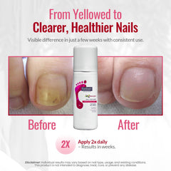 FOOTLOGIX being sprayed onto a toenail showing easy, neat application benefit
