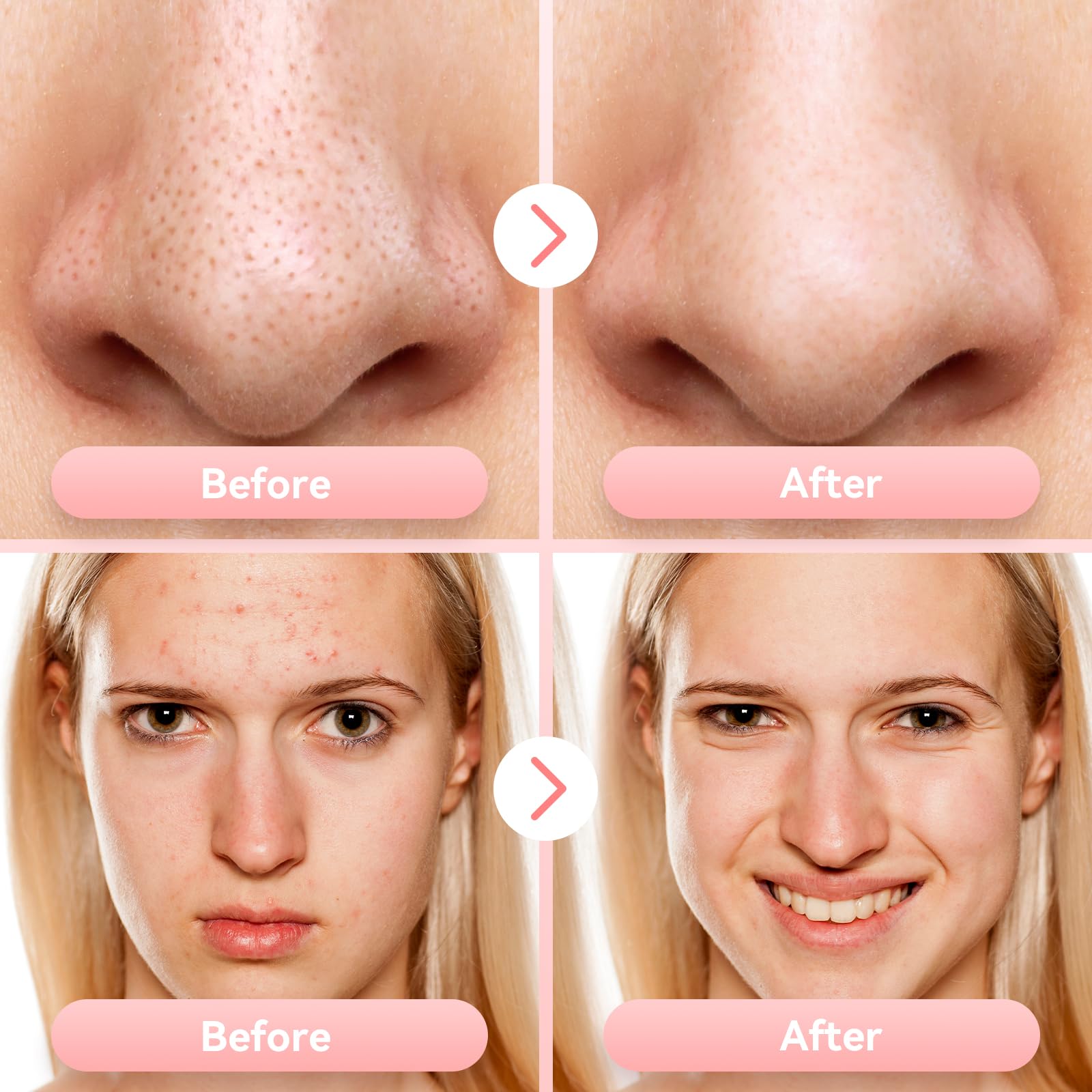 FREESHOW in-use on cheek area showing gentle extraction and clearer-looking pores