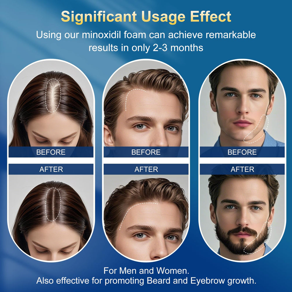 Frnoip foam being applied to scalp illustrating targeted coverage and quick absorption