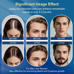 Frnoip foam being applied to scalp illustrating targeted coverage and quick absorption