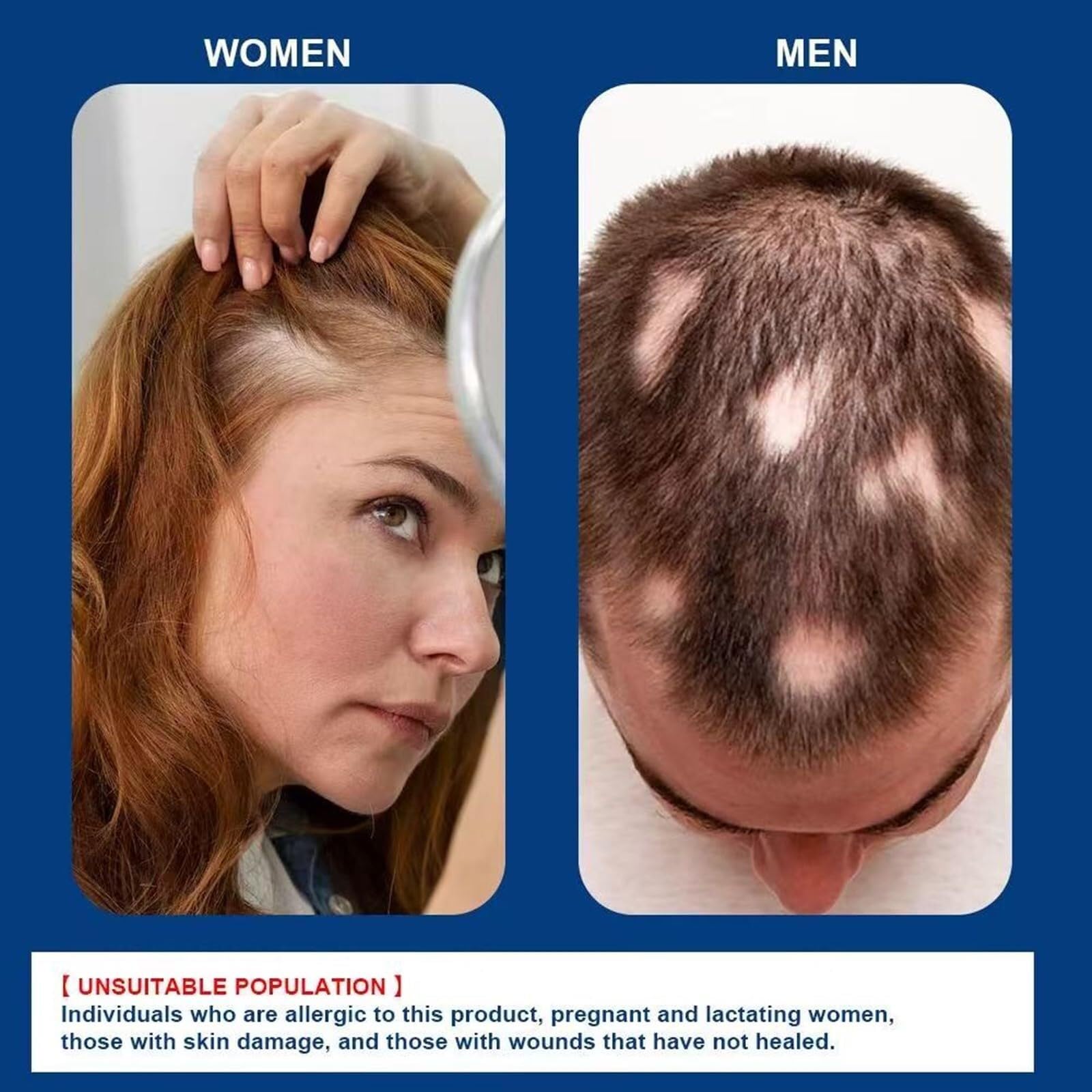 Generic alopecia cream application in hand demonstrating simple, controlled dosing benefit