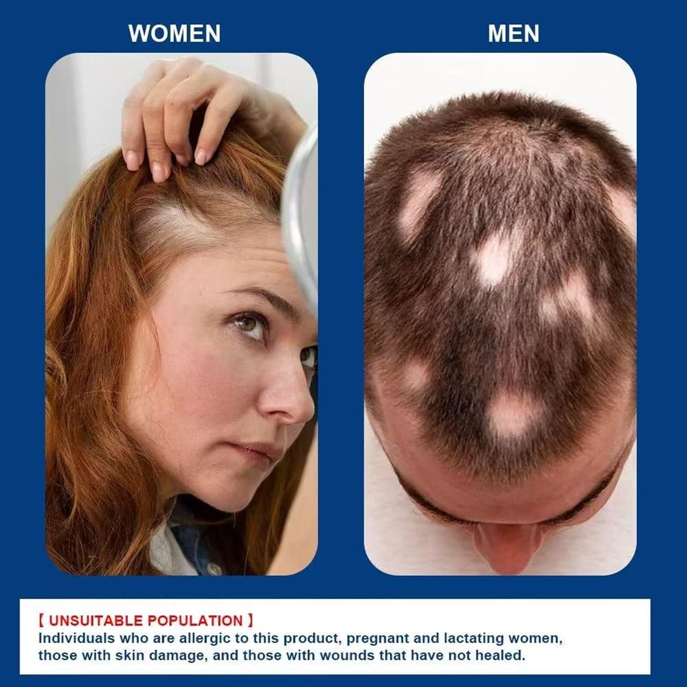 Generic alopecia cream application in hand demonstrating simple, controlled dosing benefit