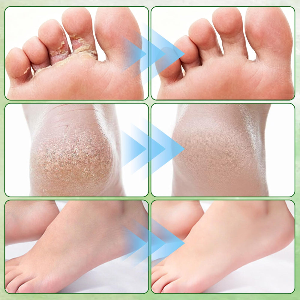 Generic tea tree foot cream being massaged onto heels for softer skin
