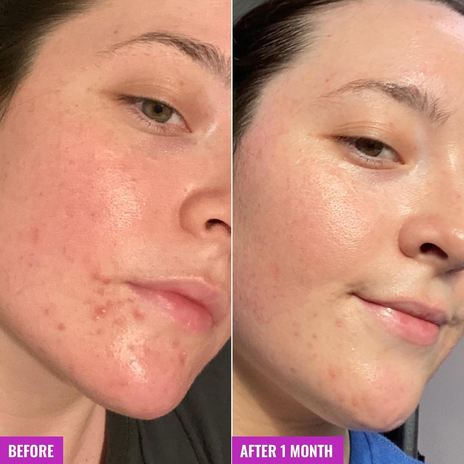 Good Molecules bar being applied to face for targeted pore-clearing routine