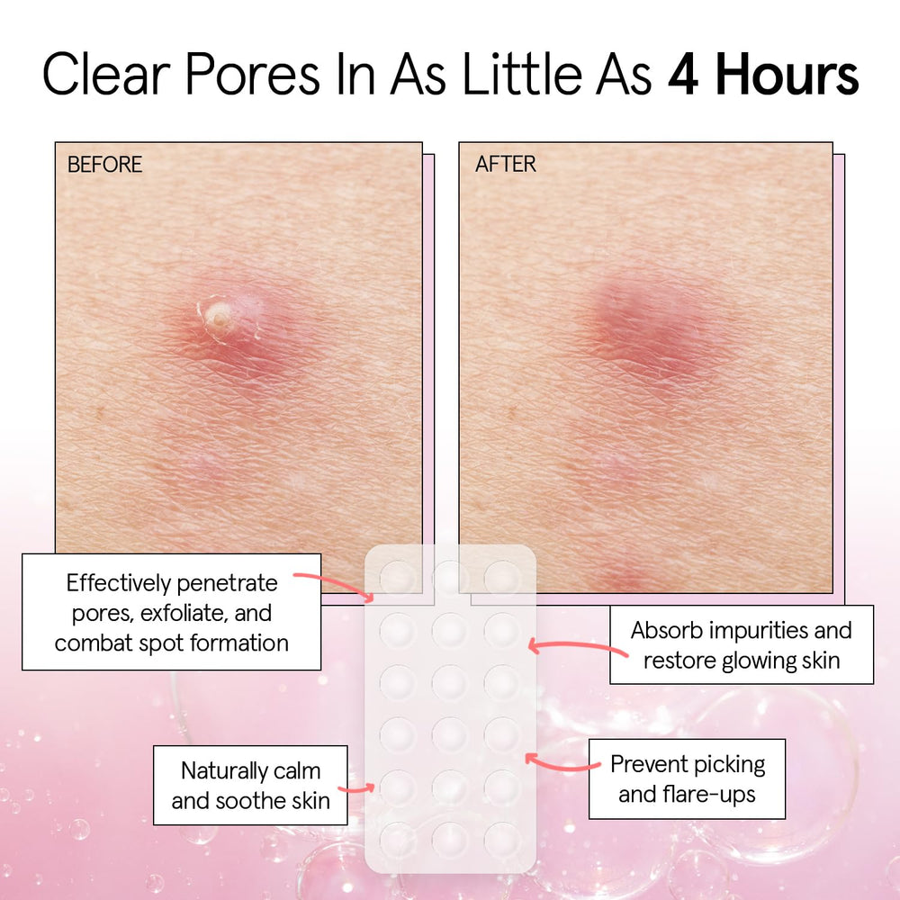 grace & stella patch applied on cheek protecting and reducing a pimple