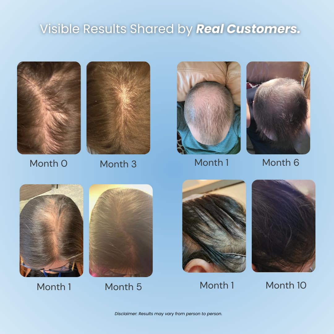 GROWPLEX being applied to thinning scalp for targeted coverage and benefit