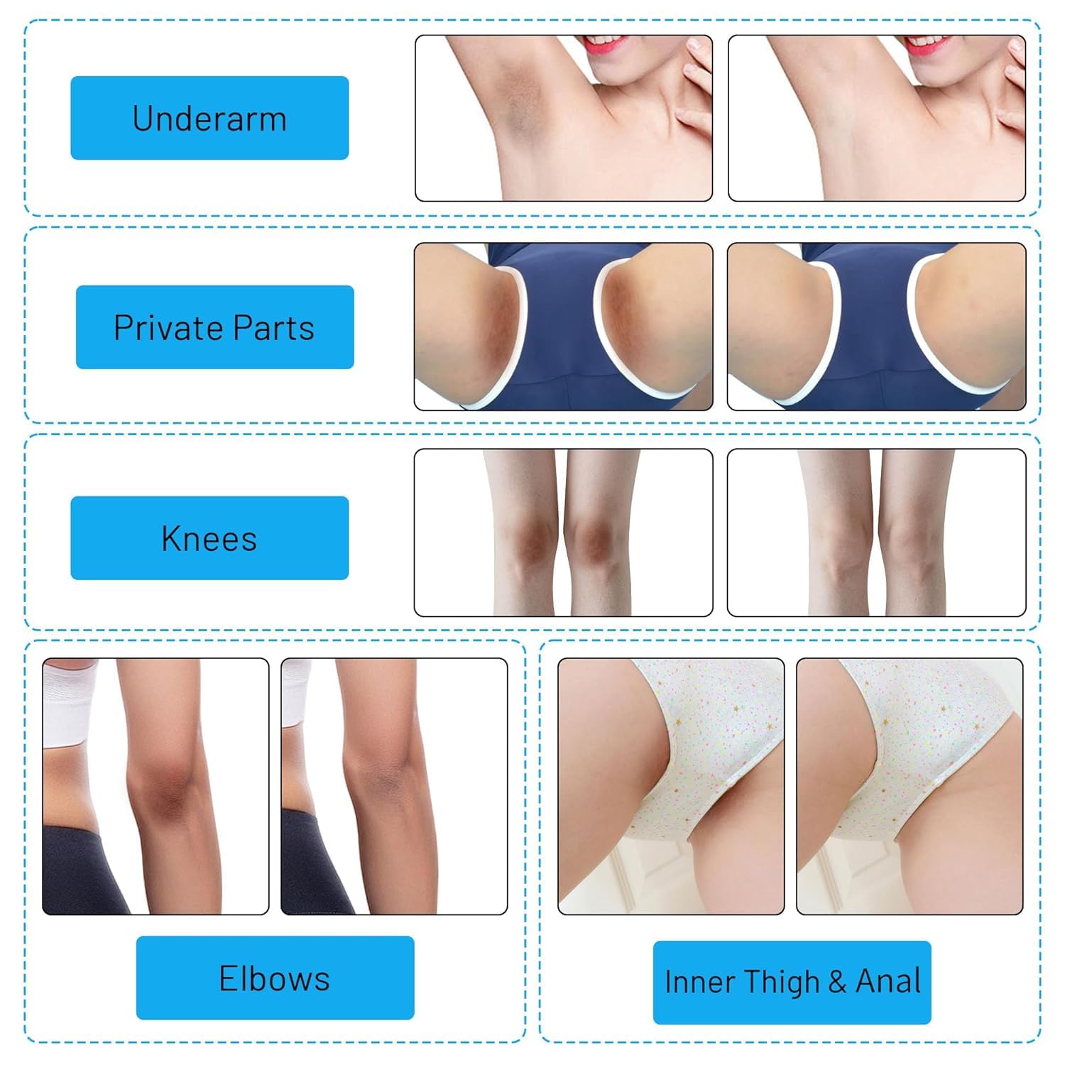 Gukei elbow and knee application showing coverage and smoothing benefit