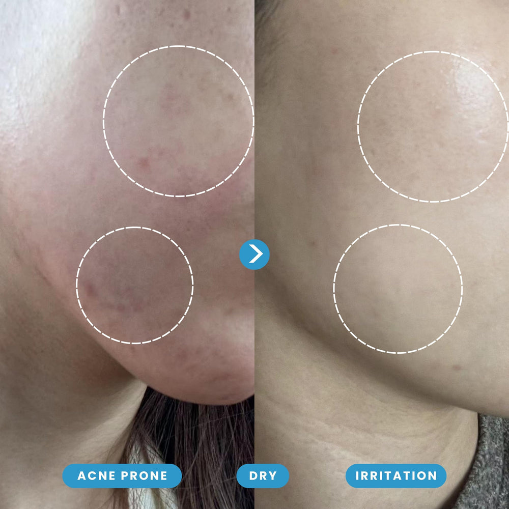 Honeydew Labs use on face demonstration calming redness and refreshing skin