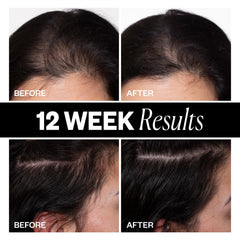 IGK treatment being applied to scalp targeting thinning areas