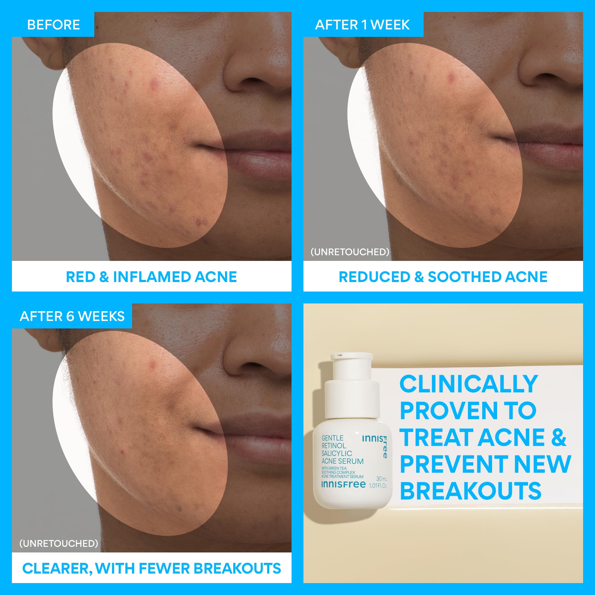 innisfree ingredient label view highlighting salicylic and retinol actives benefit
