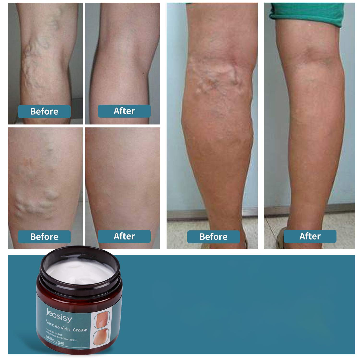 jeosisy applying cream to calf to show method and soothing benefit