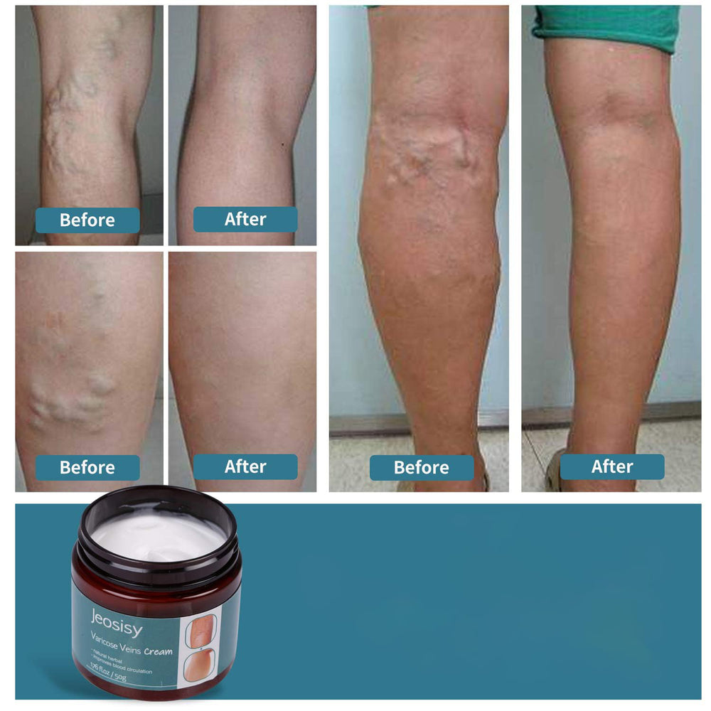 jeosisy applying cream to calf to show method and soothing benefit