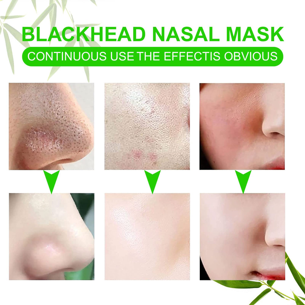 JWBVCTCR used strips with removed blackheads demonstrating effectiveness