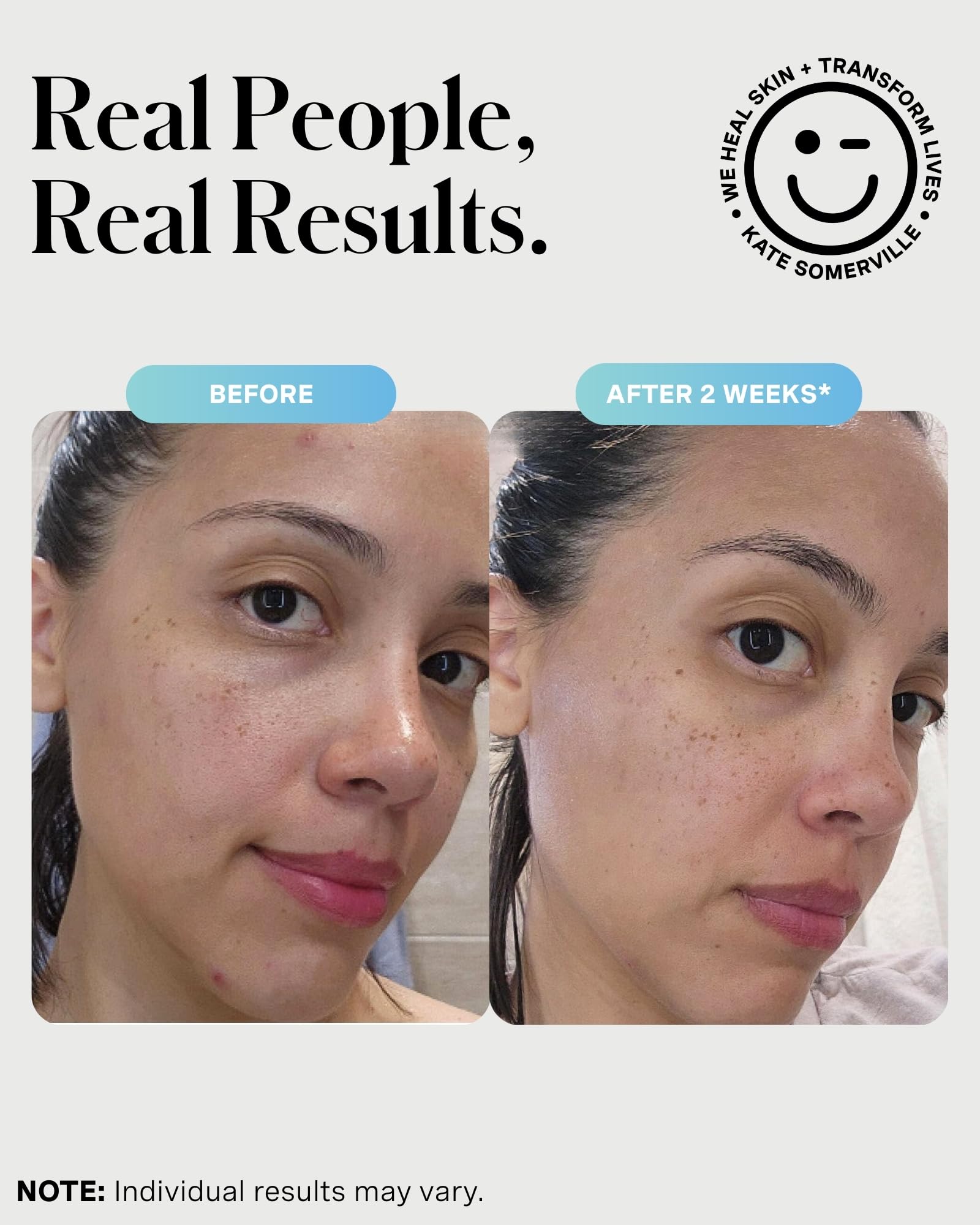 Kate Somerville mask on cheek for targeted short-contact breakout care