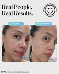 Kate Somerville mask on cheek for targeted short-contact breakout care