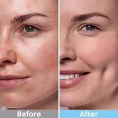 Kestper pad in use wiping cheek demonstrating pore-cleansing and oil control