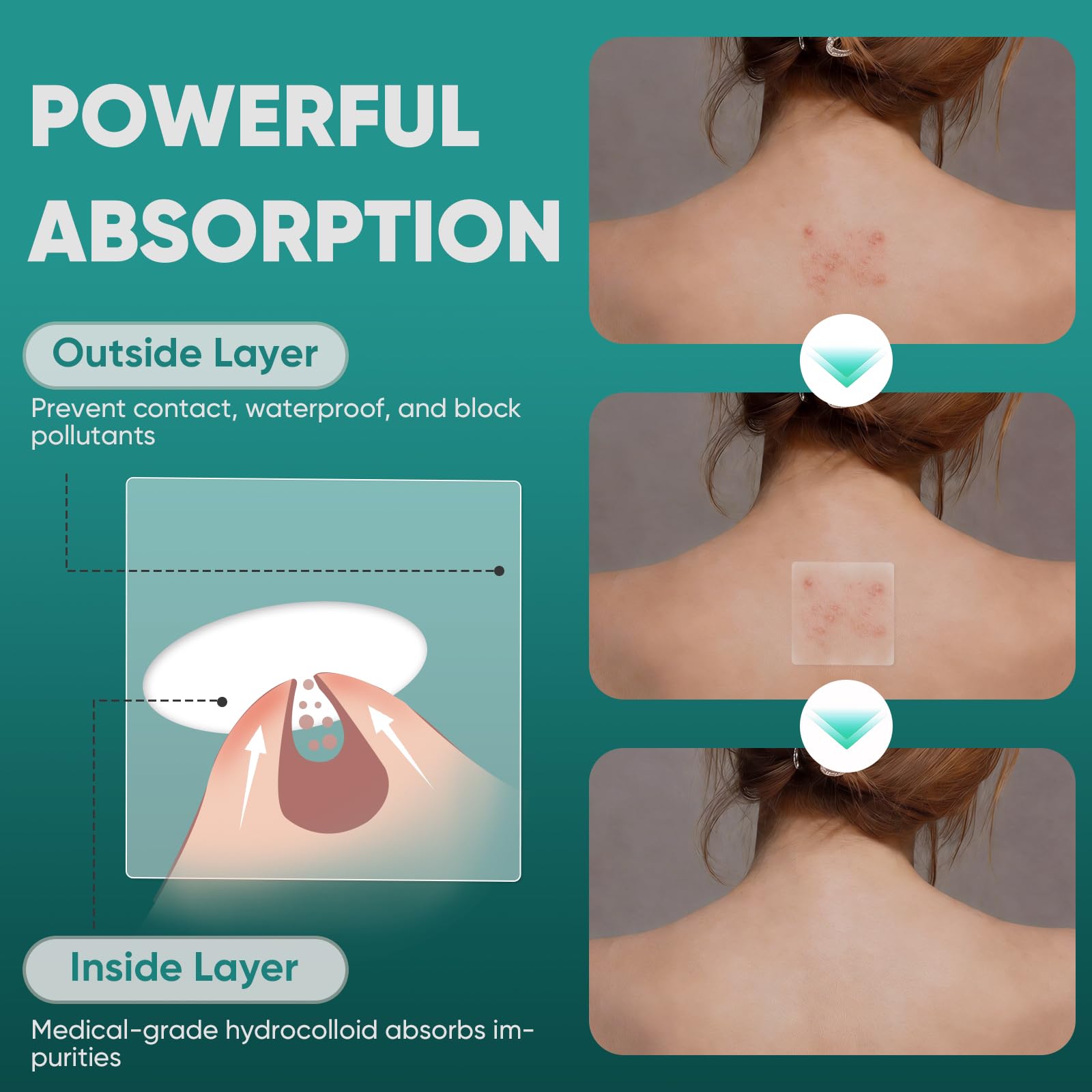 kindshine patches covering back acne offering targeted coverage