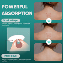 kindshine patches covering back acne offering targeted coverage