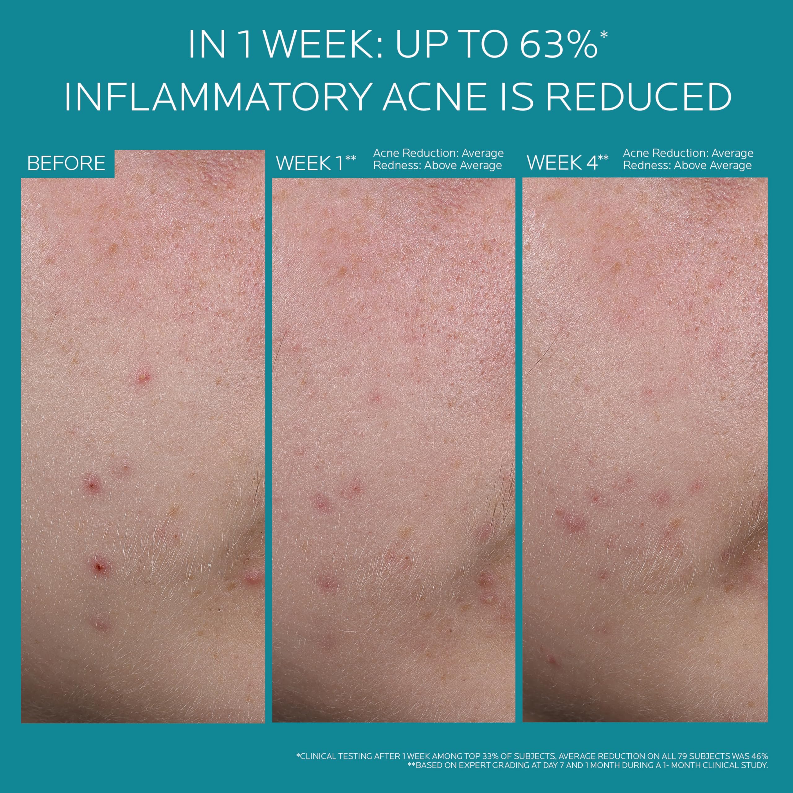 La Roche-Posay conceptual before and after showing reduced inflammation