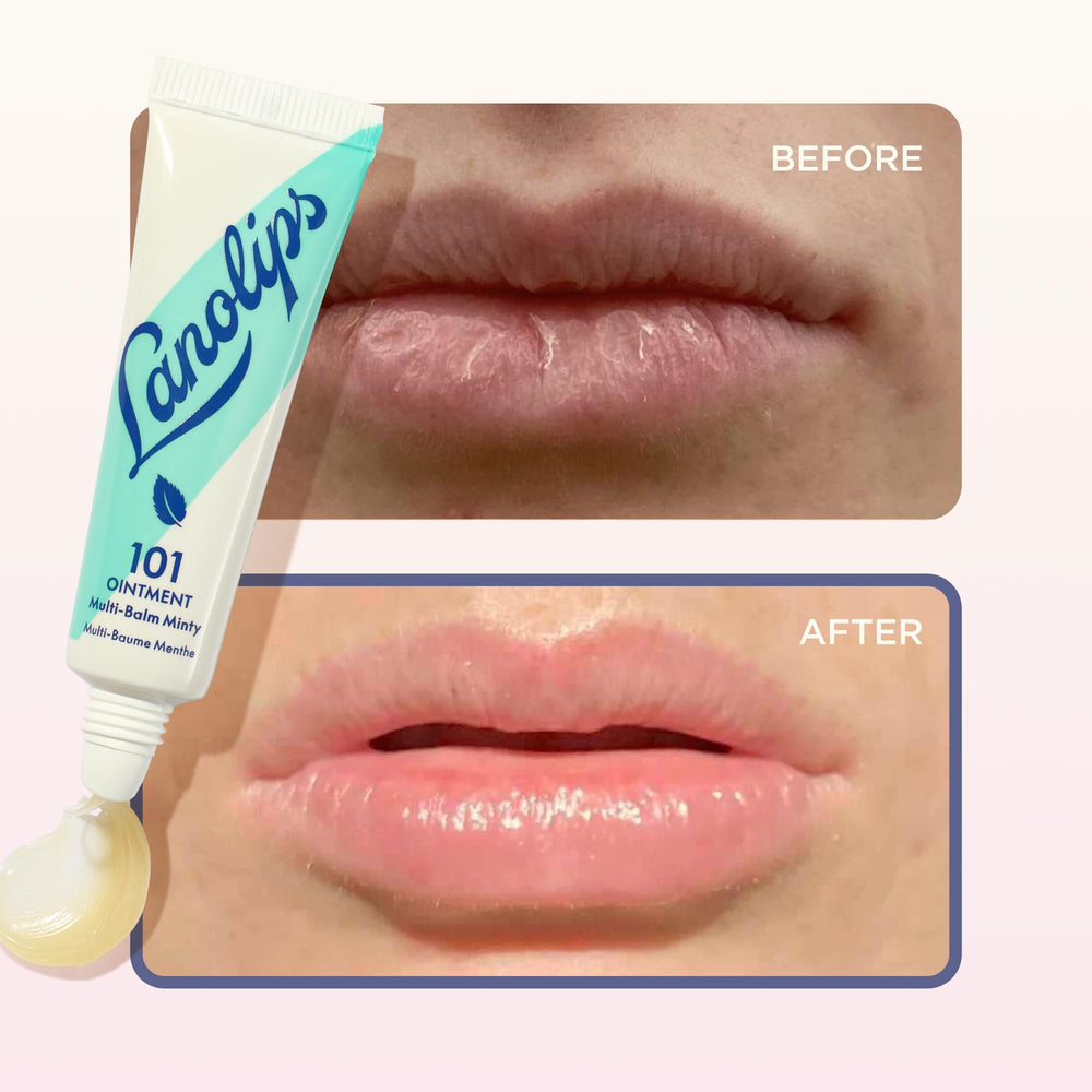 Using Lanolips 101 on cuticles to soften skin and prevent hangnails effectively