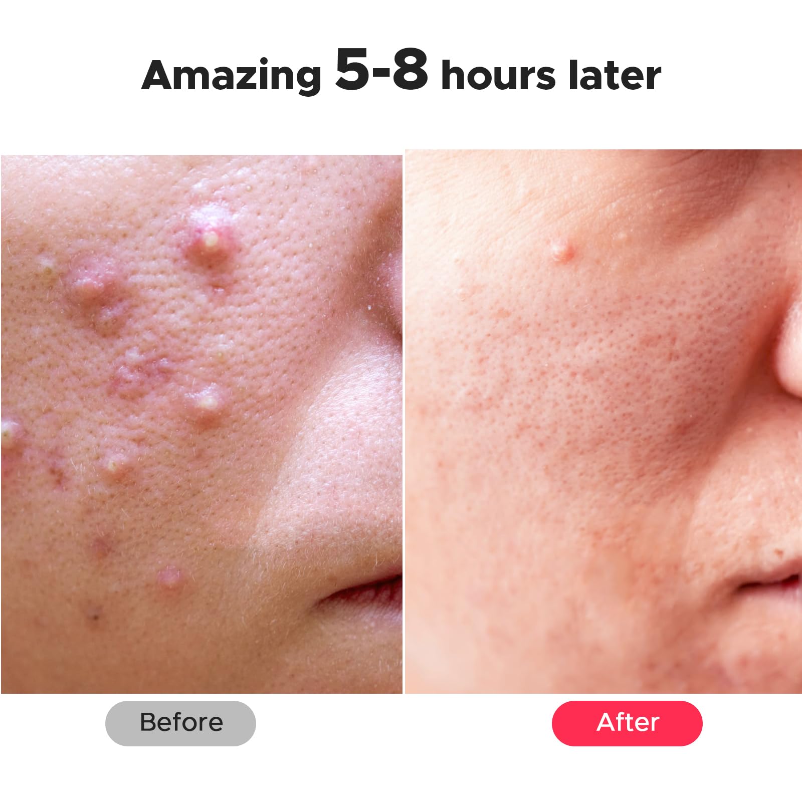 LitBear transparent patch worn on cheek showing discreet look benefit: subtle camouflage