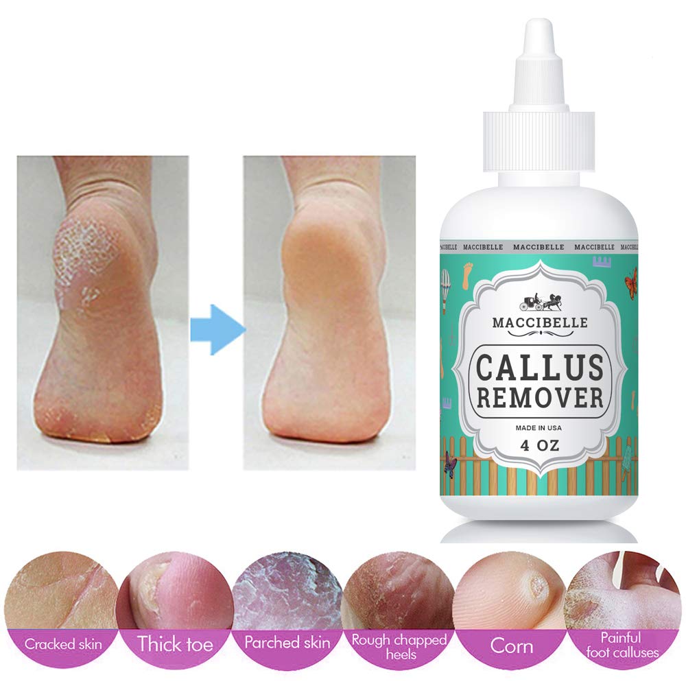 Maccibelle gel applied to heel close-up demonstrating targeted softening benefit