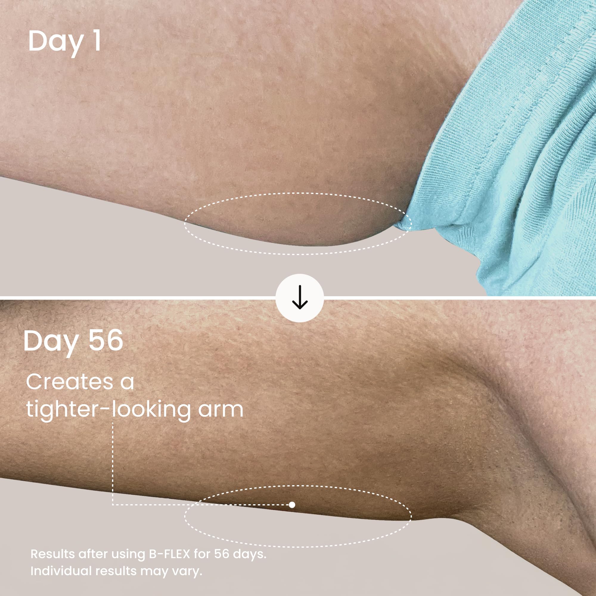 MAËLYS B-FLEX being applied to upper arm for smoother appearance