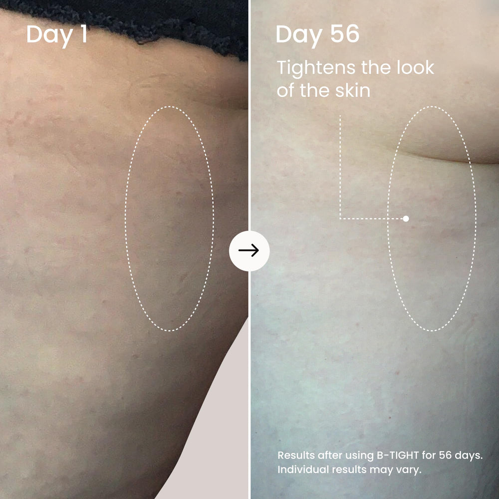 MAËLYS before and after scale illustrating visible smoothing of skin texture