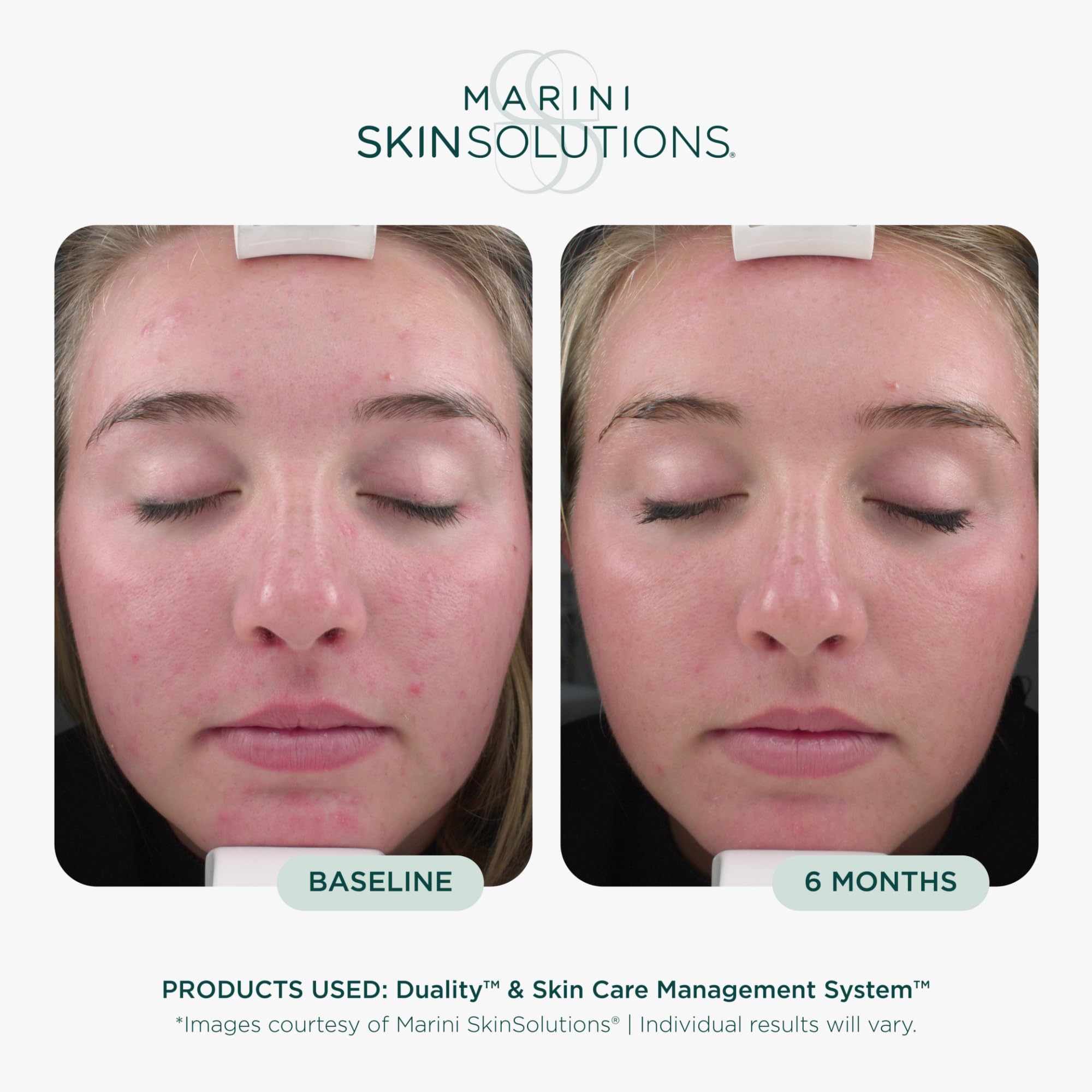 Marini SkinSolutions pump dispensing product ready to mix and apply