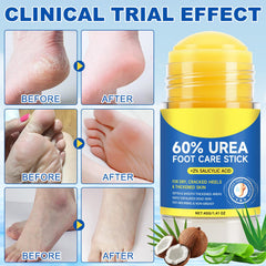 Mcukv stick applied to heel in use delivering targeted callus treatment
