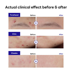 MEDIHEAL close-up on ultra-thin 0.18mm patch texture highlighting near-invisibility