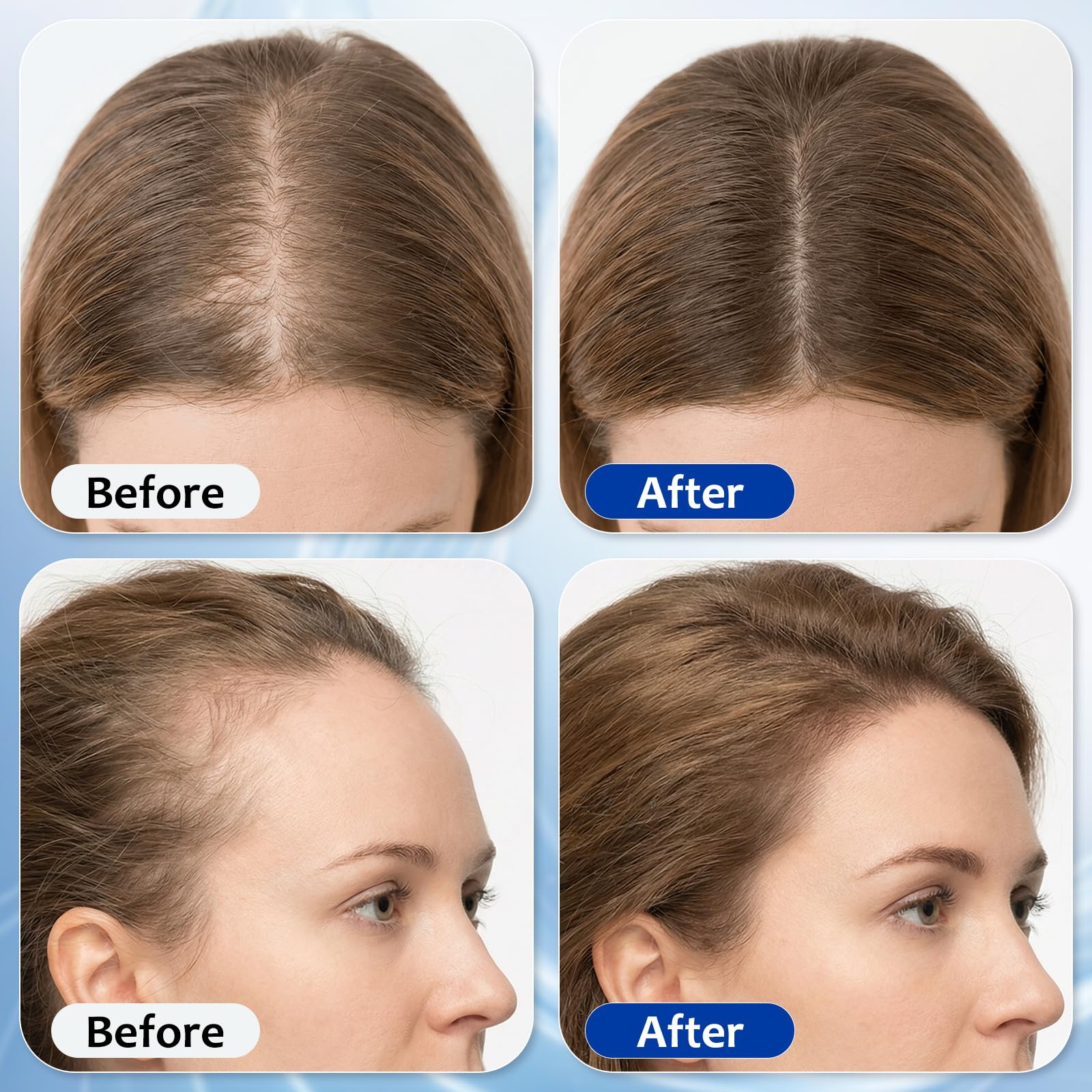 MGVAASURC roll-on being applied to scalp demonstrating targeted application and ease of use