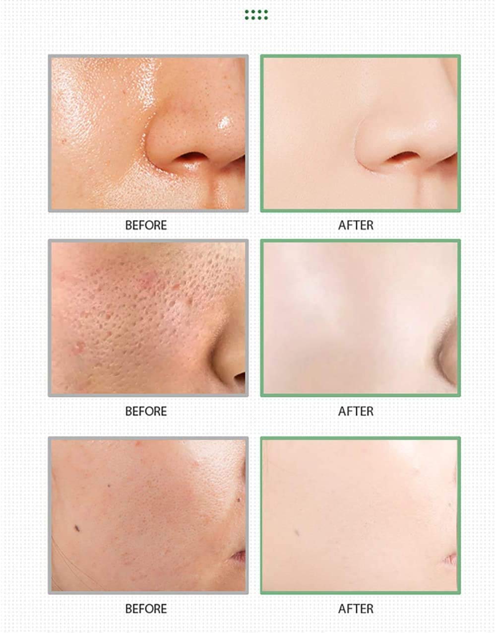 MISEDI stick applied to nose area demonstrating targeted pore cleansing