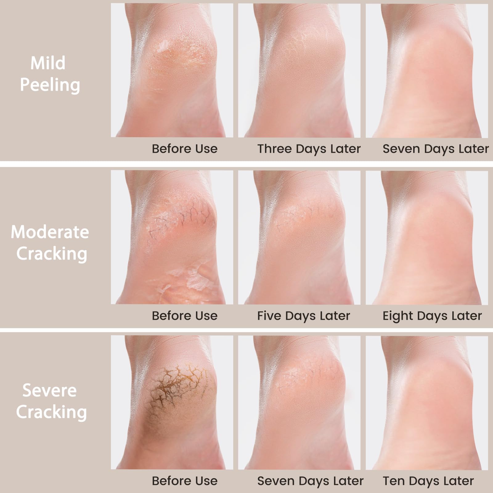 Mouriven before and after feet photo, illustrates visible smoothing benefit