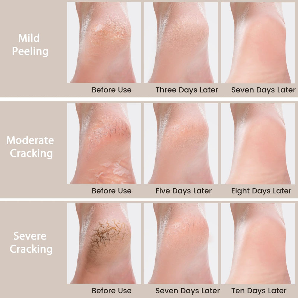 Mouriven before and after feet photo, illustrates visible smoothing benefit