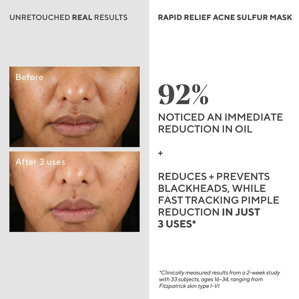 Murad mask applied on clean face, demonstrating easy at-home treatment benefits