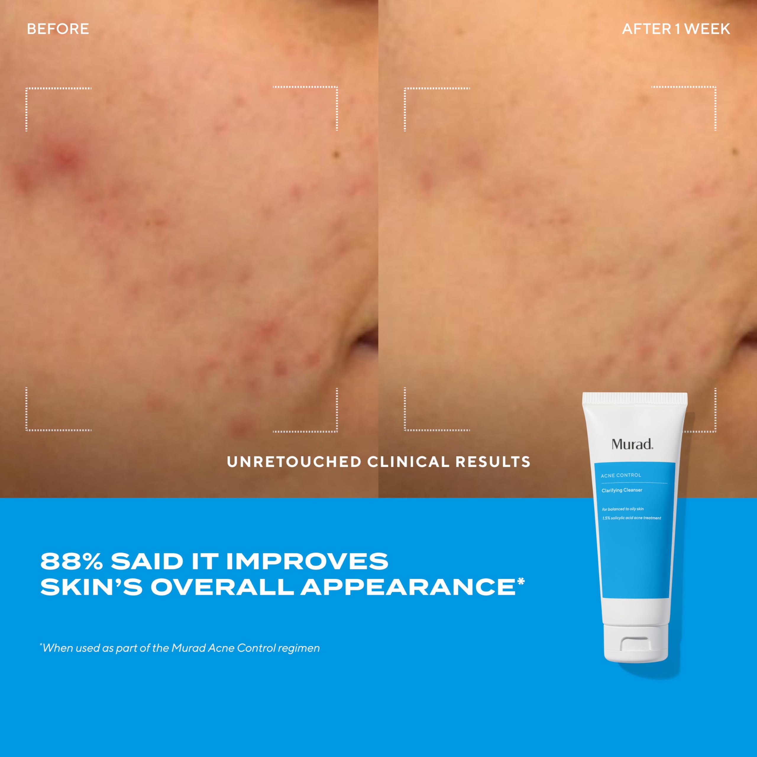 Murad spot treatment tube for fast blemish-targeted care