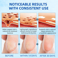 MZWFAH before and after heels comparison showing smoother, softened skin