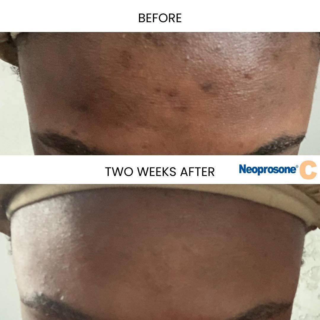 Neoprosone serum texture spread on skin, lightweight finish for quick absorption